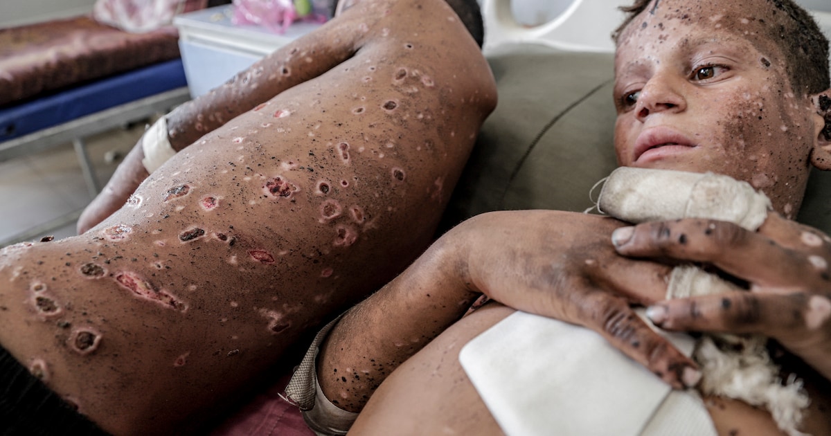 Almere is bereid zieke kinderen uit Gaza op te vangen: ‘Opvang en begeleiding is haalbaar’